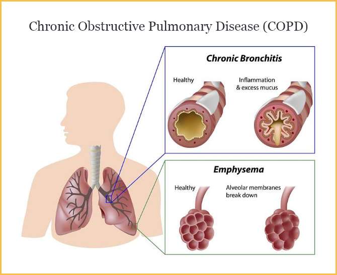 COPD Understanding The Disease And Managing Symptoms ThePurePulse